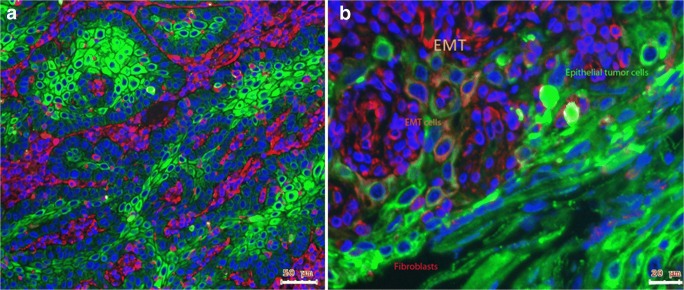 Pleiotropic Effects of Epithelial Mesenchymal Crosstalk on Head and Neck Cancer: EMT and beyond.