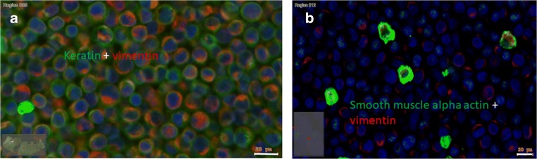 Pleiotropic Effects of Epithelial Mesenchymal Crosstalk on Head and Neck Cancer: EMT and beyond.