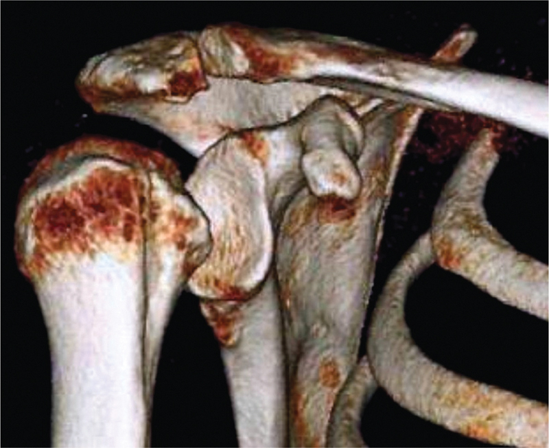 All-Arthroscopic McLaughlin's Procedure in Patients with Reverse Hill-Sachs Lesion Caused by Locked Posterior Shoulder Dislocation.