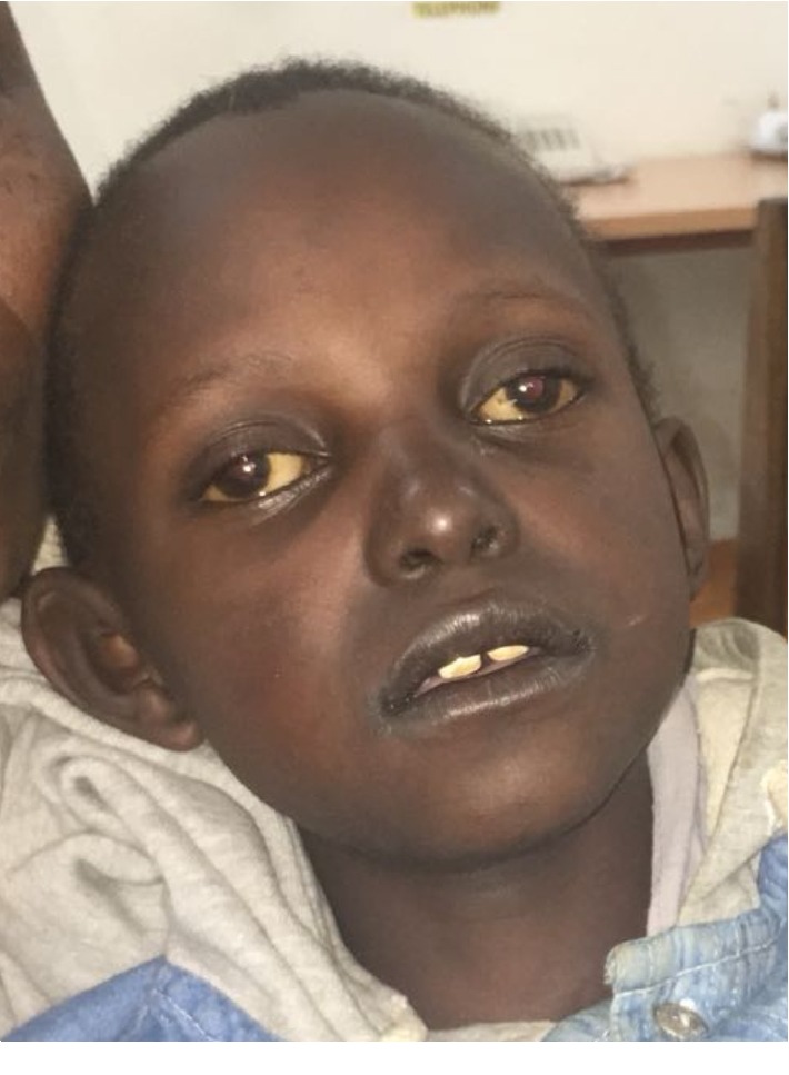 A Tanzanian Boy with Molecularly Confirmed X-Linked Adrenoleukodystrophy.