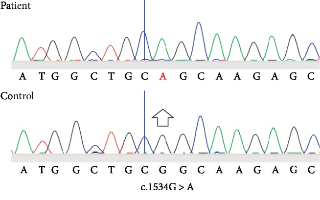 A Tanzanian Boy with Molecularly Confirmed X-Linked Adrenoleukodystrophy.