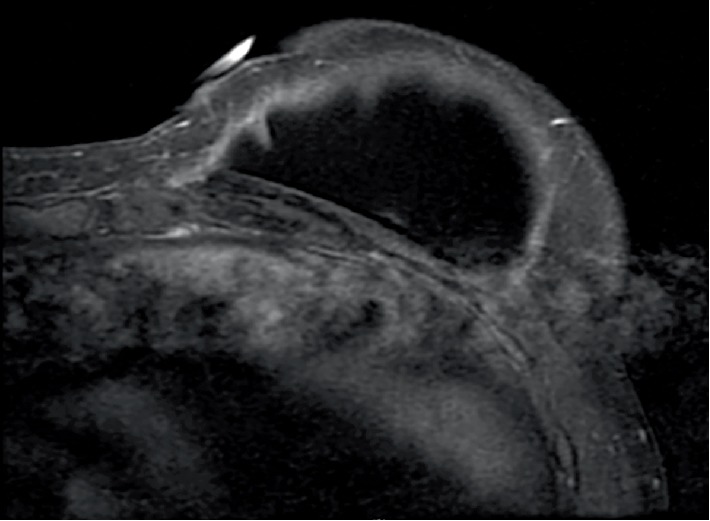 Cryoablation of a Symptomatic Chest Wall Desmoid Tumor Underneath a Silicone Breast Implant.