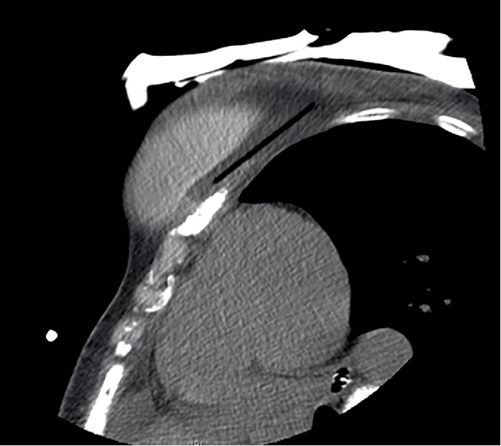 Cryoablation of a Symptomatic Chest Wall Desmoid Tumor Underneath a Silicone Breast Implant.