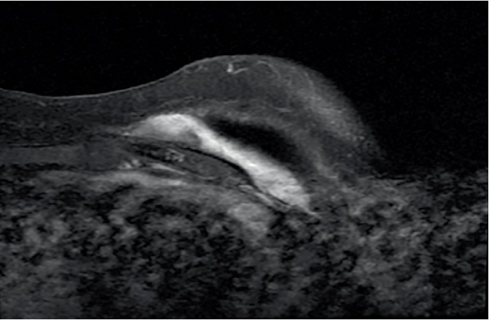 Cryoablation of a Symptomatic Chest Wall Desmoid Tumor Underneath a Silicone Breast Implant.