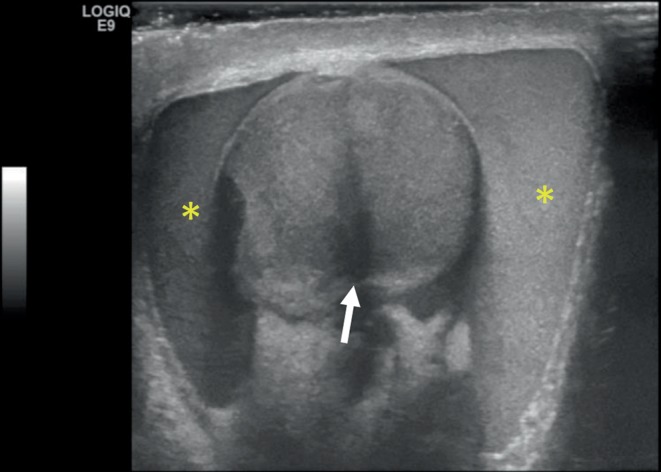 Testicular Rupture Following Blunt Scrotal Trauma.