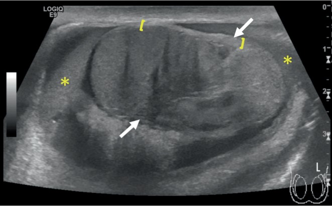 Testicular Rupture Following Blunt Scrotal Trauma.