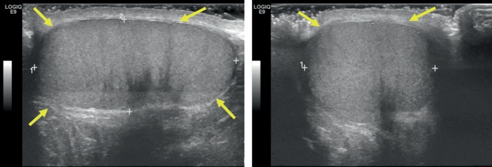 Testicular Rupture Following Blunt Scrotal Trauma.