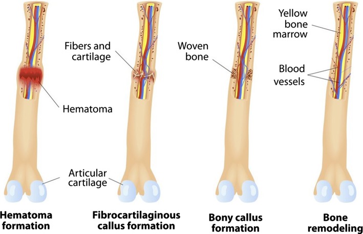 Bone tissue regeneration: biology, strategies and interface studies.