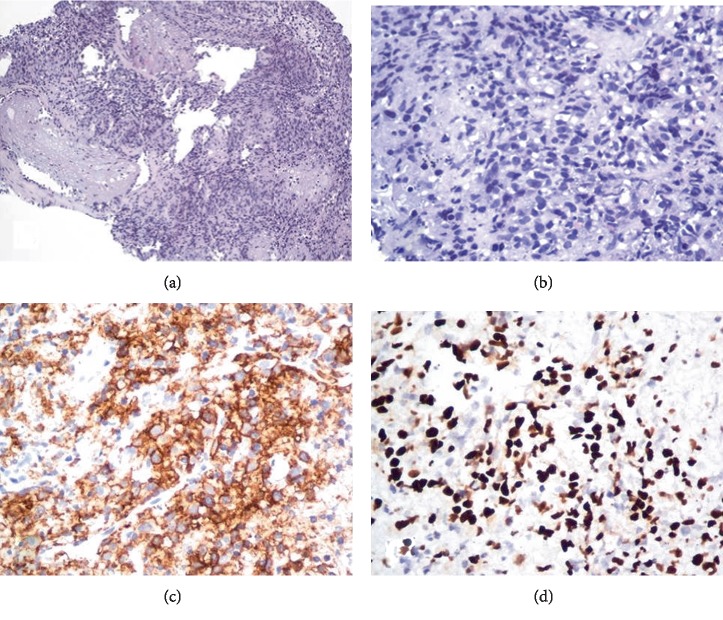 Fatal Hypogammaglobulinemia 3 Years after Rituximab in a Patient with Immune Thrombocytopenia: An Underlying Genetic Predisposition?