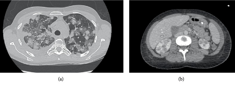 Fatal Hypogammaglobulinemia 3 Years after Rituximab in a Patient with Immune Thrombocytopenia: An Underlying Genetic Predisposition?