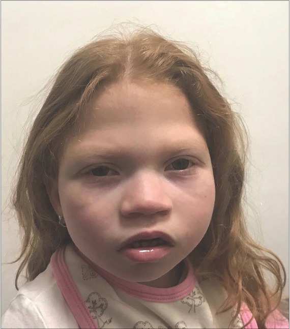 Clinical Next Generation Sequencing Reveals an <i>H3F3A</i> Gene as a New Potential Gene Candidate for Microcephaly Associated with Severe Developmental Delay, Intellectual Disability and Growth Retardation.