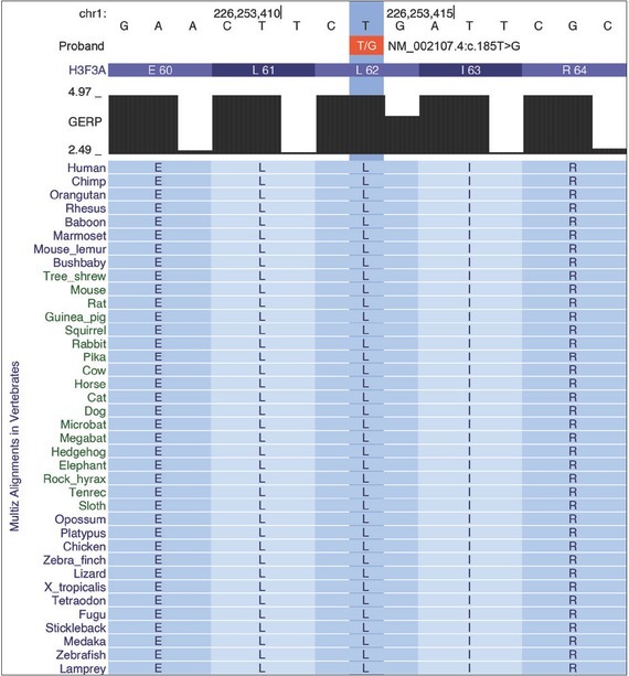 Clinical Next Generation Sequencing Reveals an <i>H3F3A</i> Gene as a New Potential Gene Candidate for Microcephaly Associated with Severe Developmental Delay, Intellectual Disability and Growth Retardation.