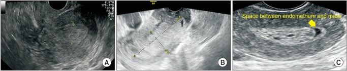 Thick "Swiss Cheese" Appearance of Uterine Endometrium in Postmenopausal Women with Different Gynecologic Conditions.