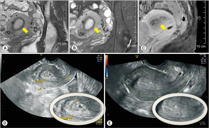 Thick "Swiss Cheese" Appearance of Uterine Endometrium in Postmenopausal Women with Different Gynecologic Conditions.