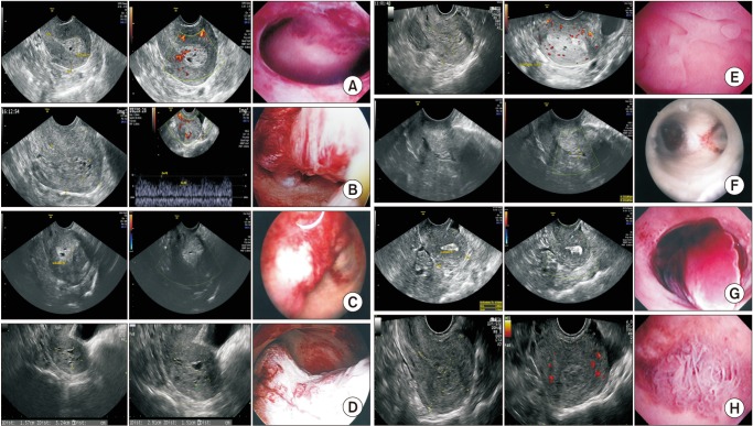 Thick "Swiss Cheese" Appearance of Uterine Endometrium in Postmenopausal Women with Different Gynecologic Conditions.