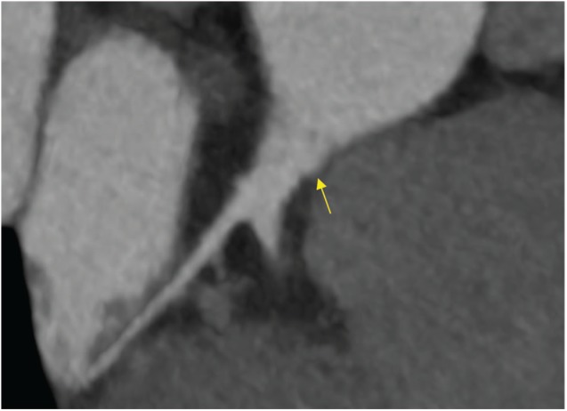 Left Main Coronary Artery Thrombus Diagnosed and Managed With Coronary Computed Tomography Angiography and Fractional Flow Reserve Derived From Computed Tomography.