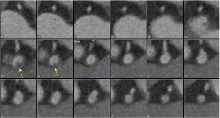 Left Main Coronary Artery Thrombus Diagnosed and Managed With Coronary Computed Tomography Angiography and Fractional Flow Reserve Derived From Computed Tomography.