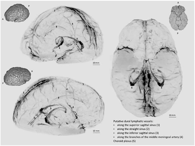 Meningeal Lymphatics: A Review and Future Directions From a Clinical Perspective.