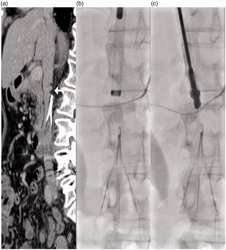 Renal artery injury during inferior vena cava filter removal with endobronchial forceps.