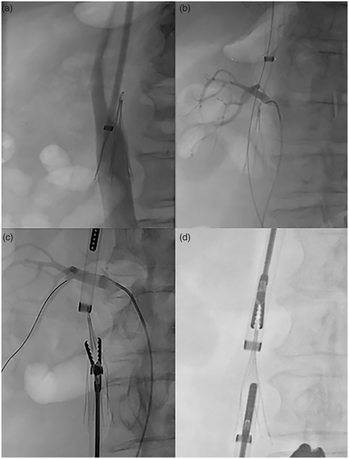 Renal artery injury during inferior vena cava filter removal with endobronchial forceps.