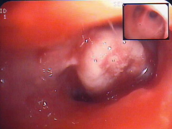 Approaches to Tumor Classification in Pulmonary Sarcomatoid Carcinoma.