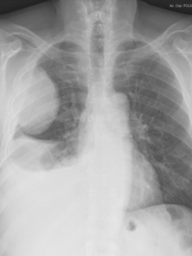 Approaches to Tumor Classification in Pulmonary Sarcomatoid Carcinoma.