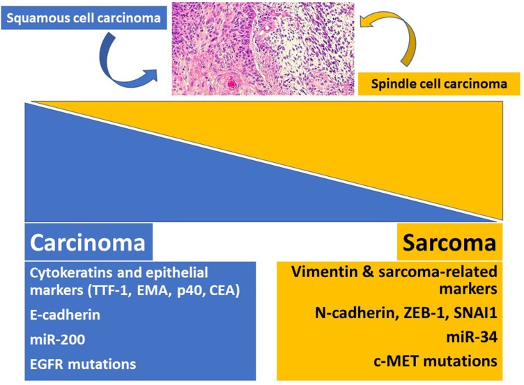 Approaches to Tumor Classification in Pulmonary Sarcomatoid Carcinoma.