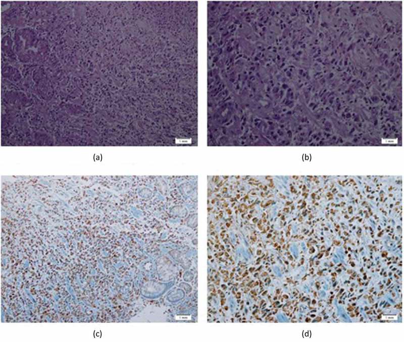 Prevalence of Her3 in gastric cancer and its association with molecular prognostic markers: a Saudi cohort based study.