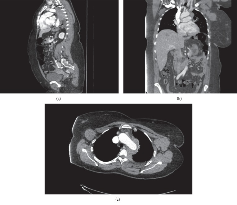 An Unusual Initial Presentation of Diffuse Large B-Cell Lymphoma as Recurrent Syncope.