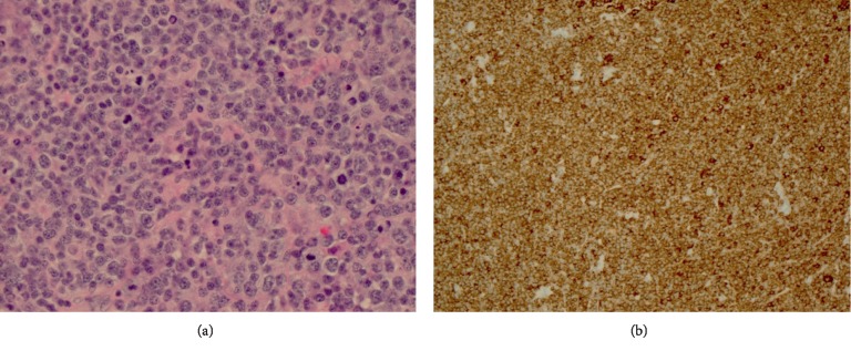 An Unusual Initial Presentation of Diffuse Large B-Cell Lymphoma as Recurrent Syncope.