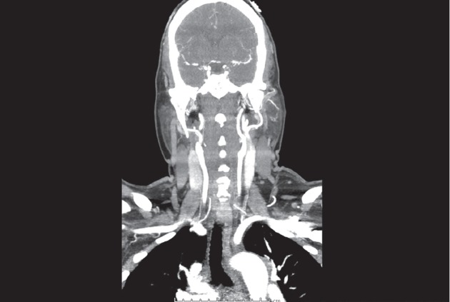 An Unusual Initial Presentation of Diffuse Large B-Cell Lymphoma as Recurrent Syncope.