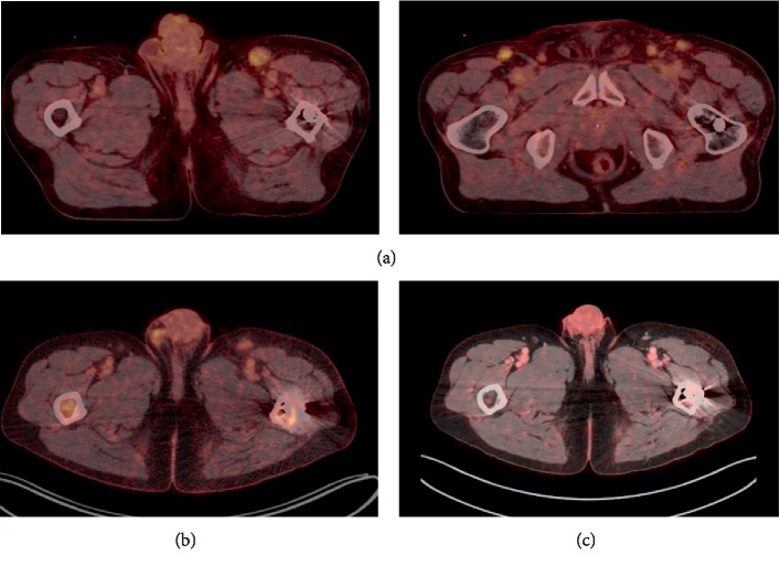 Severely Disseminated Kaposi Sarcoma after ABO-Incompatible Kidney Transplantation Treated Successfully with Paclitaxel and Gemcitabine Combined with Hemodialysis.