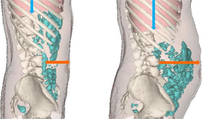Abdominal distension after eating lettuce: The role of intestinal gas evaluated in vitro and by abdominal CT imaging.