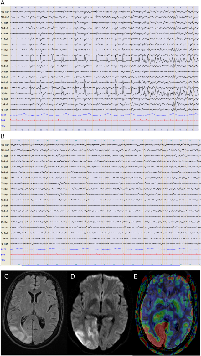 Perampanel: A therapeutic alternative in refractory status epilepticus associated with MELAS syndrome