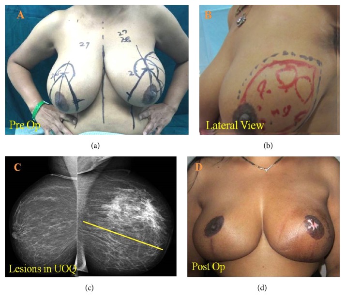 Extreme Oncoplastic Surgery for Multifocal/Multicentric and Locally Advanced Breast Cancer.