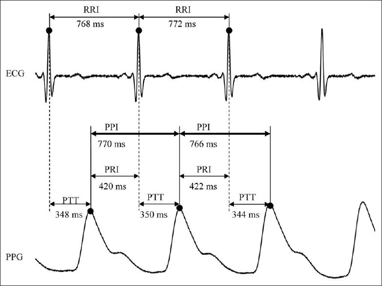 Compatibility of pulse-pulse intervals with R-R intervals in assessing cardiac autonomic function and its relation to risks of atherosclerosis.