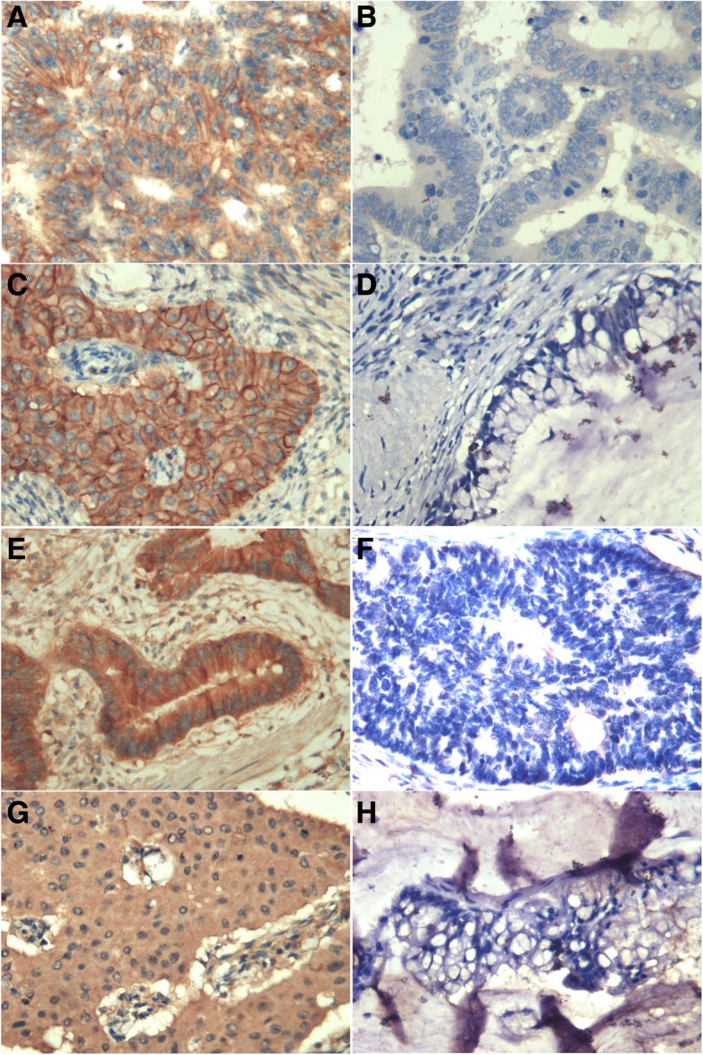 Clinical significance of HER2 and EGFR expression in colorectal cancer patients with ovarian metastasis.