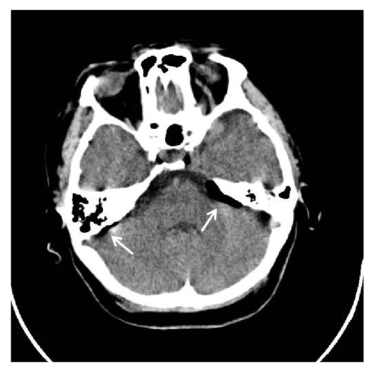 Pneumocephalus and Meningitis as Complications of Mastoiditis.