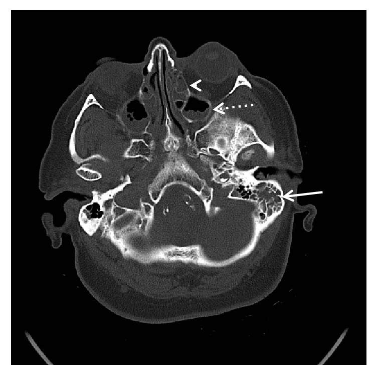 Pneumocephalus and Meningitis as Complications of Mastoiditis.