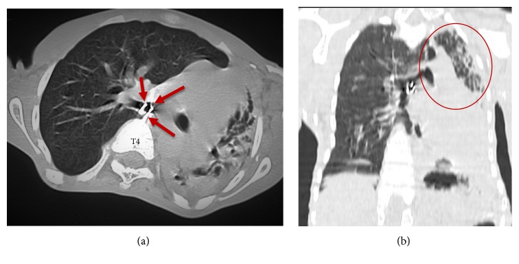 A Case of Progressive Ossifying Fibrodysplasia of Tracheobronchial Respiratory Muscles.