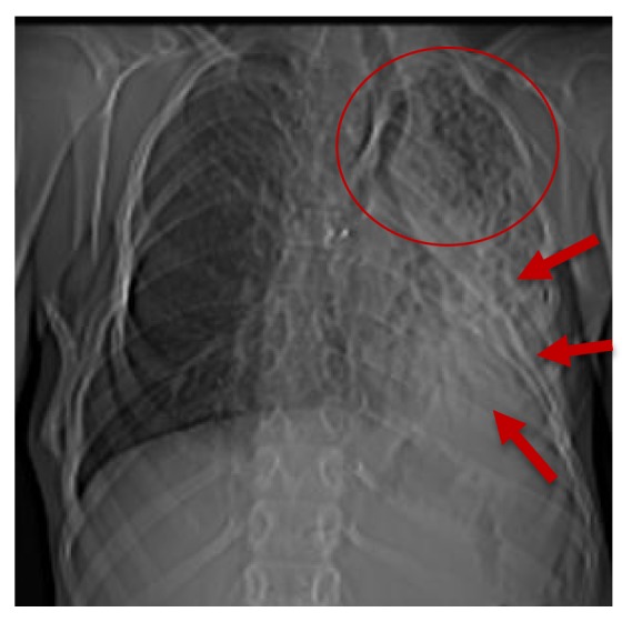 A Case of Progressive Ossifying Fibrodysplasia of Tracheobronchial Respiratory Muscles.