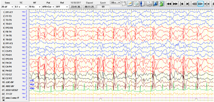 Hemi-ESES associated with agenesis of the corpus callosum and normal cognition