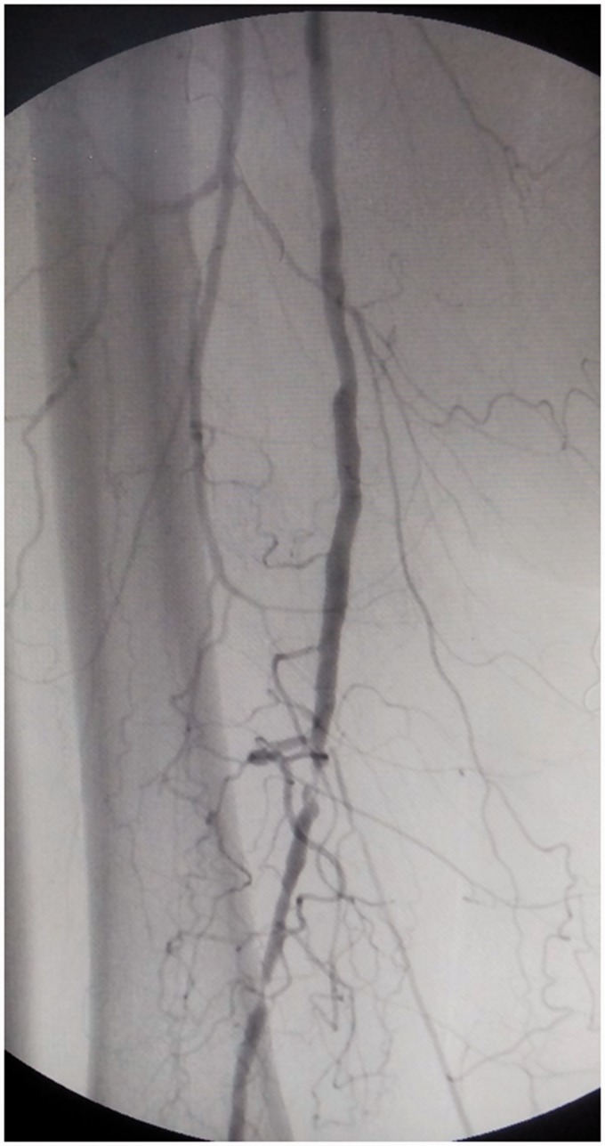 Impact of calcification and infrapopliteal outflow on the outcome of endovascular treatment of femoropopliteal occlusive disease.