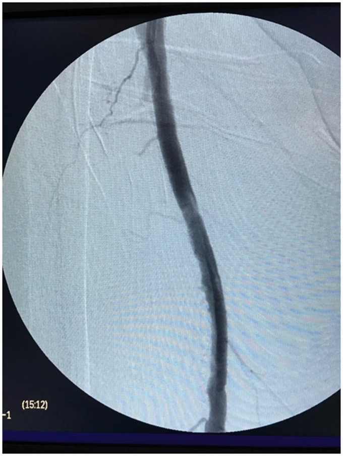 Impact of calcification and infrapopliteal outflow on the outcome of endovascular treatment of femoropopliteal occlusive disease.