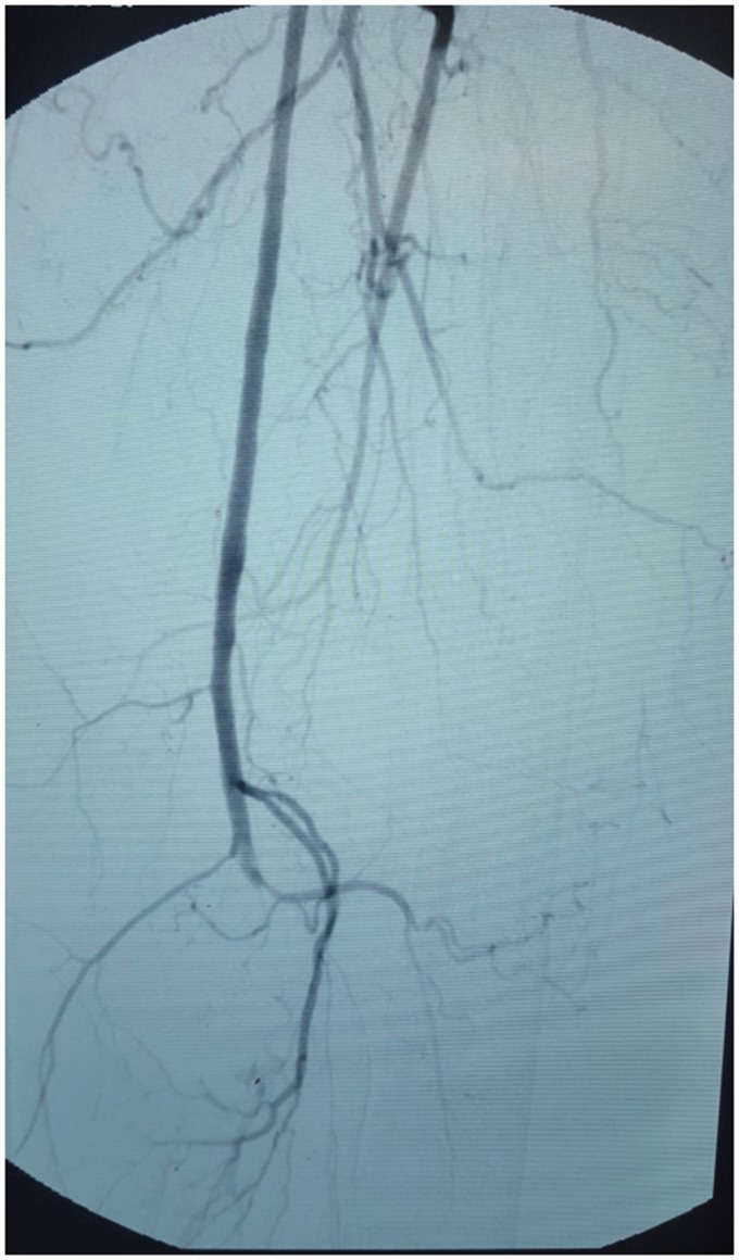 Impact of calcification and infrapopliteal outflow on the outcome of endovascular treatment of femoropopliteal occlusive disease.