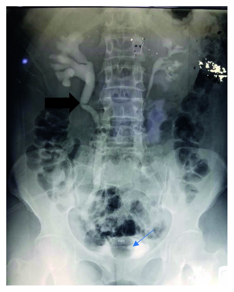 Our Experience with Iatrogenic Ureteric Injuries among Women Presenting to University College Hospital, Ibadan: A Call to Action on Trigger Factors.