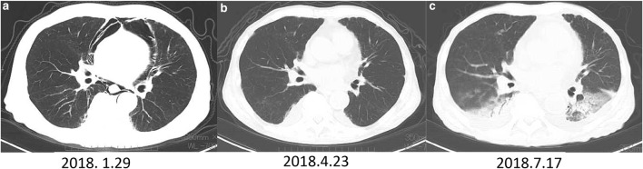 Ibrutinib Caused Mediastinal Emphysema and Pneumothorax in the Treatment of a Patient with Mantle Cell Lymphoma.