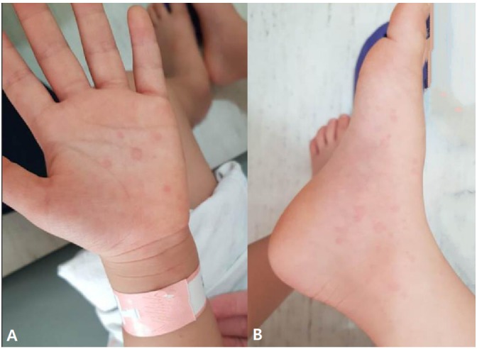 Drug eruption by antihistamine mistaken for chronic urticaria in a child.