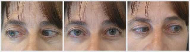 Bilateral, Unaugmented, Loop Myopexy Performed for a Severe Case of Heavy Eye Syndrome.