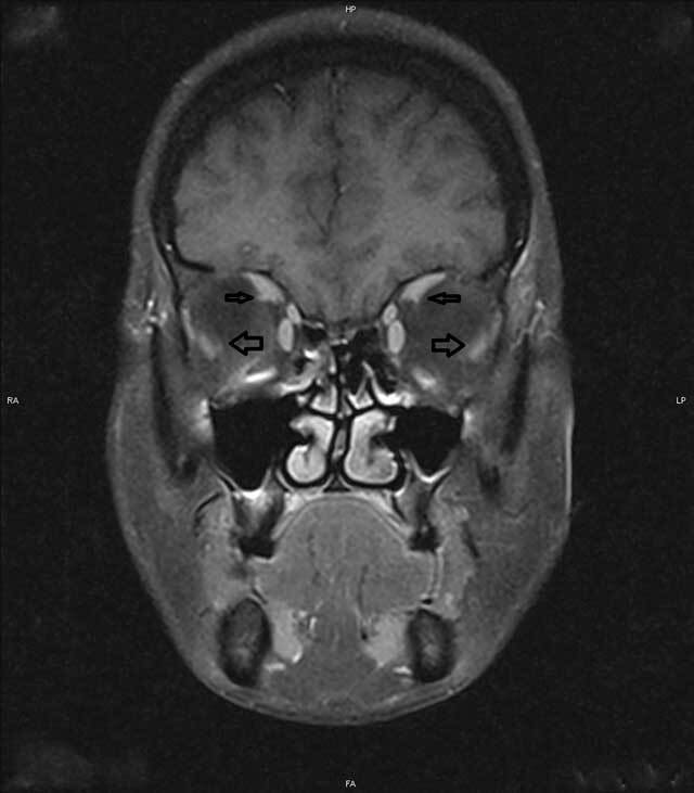 Bilateral, Unaugmented, Loop Myopexy Performed for a Severe Case of Heavy Eye Syndrome.